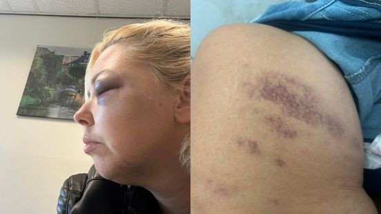 Vrouw (37) met boksbeugel in gezicht geslagen: telefoon, sleutels én trouwe viervoeter buitgemaakt