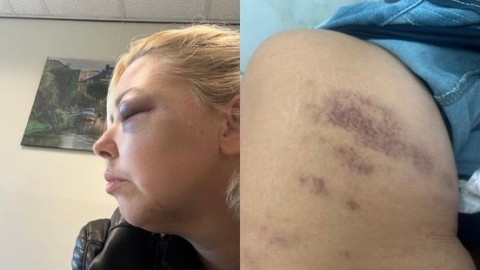 Vrouw (37) met boksbeugel in gezicht geslagen: telefoon, sleutels én trouwe viervoeter buitgemaakt
